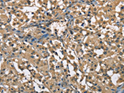 The image on the left is immunohistochemistry of paraffin-embedded Human thyroid cancer tissue using ENO1 Antibody(ENO1 Antibody) at dilution 1/60, on the right is treated with fusion protein. (Original magnification: ×200)Rabbit anti-Human ENO1 Polyclonal Antibody