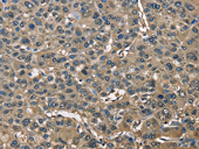 The image on the left is immunohistochemistry of paraffin-embedded Human liver cancer tissue using the antibody Antibody) at dilution 1/60, on the right is treated with fusion protein. (Original magnification: ×200)Rabbit anti-Human ENO1 Polyclonal Antibody