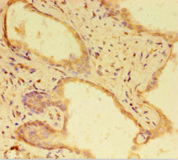 Immunohistochemistry of paraffin-embedded human prostate cancer using the antibody at dilution of 1:100