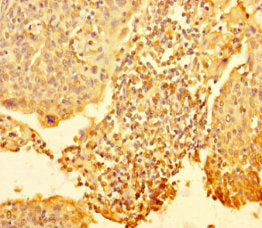 Immunohistochemistry of paraffin-embedded human cervical cancer using RTF1 Antibody at dilution of 1:100