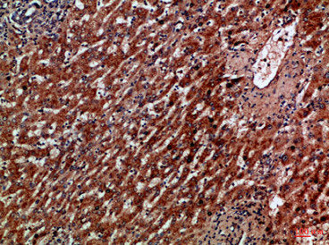 Immunohistochemical analysis of paraffin-embedded Human-liver-cancer, antibody was diluted at 1:100Rabbit anti-Human CXCR1 Polyclonal Antibody