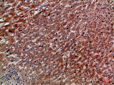 Immunohistochemical analysis of paraffin-embedded Human-liver-cancer, antibody was diluted at 1:100Rabbit anti-Human CXCR1 Polyclonal Antibody
