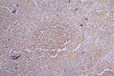 Immunohistochemistry of paraffin-embedded human  lymph node tissue using CR1 Antibody at dilution of 1:100Rabbit anti-Human CR1 Polyclonal Antibody