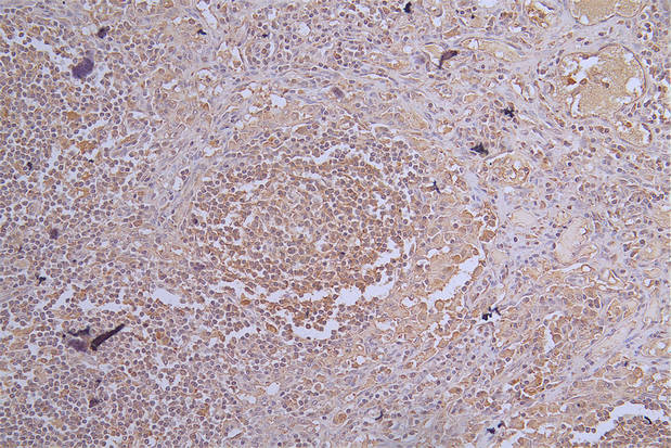 Immunohistochemistry of paraffin-embedded human  lymph node tissue using CR1 Antibody at dilution of 1:100Rabbit anti-Human CR1 Polyclonal Antibody