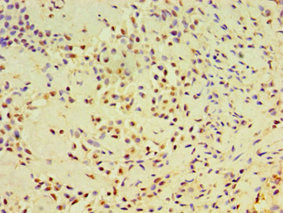 Immunohistochemistry of paraffin-embedded human breast cancer using DHX58 Antibody at dilution of 1:100Rabbit anti-Human DHX58 Polyclonal Antibody