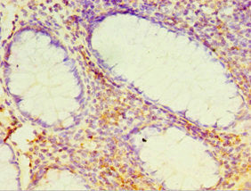 Immunohistochemistry of paraffin-embedded human colon cancer using DHX58 Antibody at dilution of 1:100Rabbit anti-Human DHX58 Polyclonal Antibody