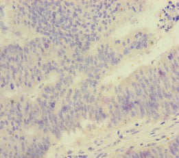 Immunohistochemistry of paraffin-embedded human colon cancer using FOXRED1 Antibody at dilution of 1:100Rabbit anti-Human FOXRED1 Polyclonal Antibody