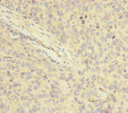 Immunohistochemistry of paraffin-embedded human ovarian cancer using FOXRED1 Antibody at dilution of 1:100Rabbit anti-Human FOXRED1 Polyclonal Antibody