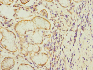 Immunohistochemistry of paraffin-embedded human gastric cancer using MTERF3 Antibody at dilution of 1:100Rabbit anti-Human MTERF3 Polyclonal Antibody