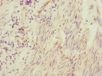 Immunohistochemistry of paraffin-embedded human bladder cancer using CEP95 Antibody at dilution of 1:100Rabbit anti-Human CEP95 Polyclonal Antibody