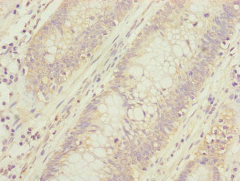 Immunohistochemistry of paraffin-embedded human colon cancer using CEP95 Antibody at dilution of 1:100Rabbit anti-Human CEP95 Polyclonal Antibody