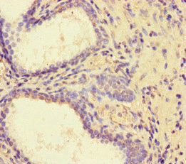 Immunohistochemistry of paraffin-embedded human prostate cancer using the antibody at dilution of 1:100Rabbit anti-Human PDLIM5 Polyclonal Antibody