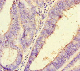 Immunohistochemistry of paraffin-embedded human endometrial cancer using PDLIM5 Antibody at dilution of 1:100Rabbit anti-Human PDLIM5 Polyclonal Antibody