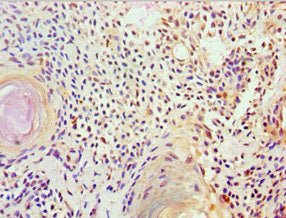 Immunohistochemistry of paraffin-embedded human breast cancer using FUBP3 Antibody at dilution of 1:100Rabbit anti-Human FUBP3 Polyclonal Antibody