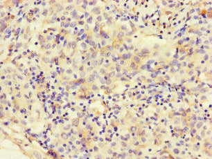 Immunohistochemistry of paraffin-embedded human lung cancer using the antibody at dilution of 1:100