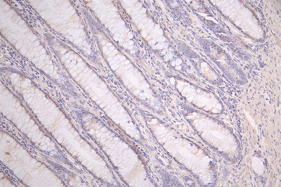 IHC image of PRIMPOL Antibody diluted at 1:50 and staining in paraffin-embedded human colorectal cancer performed on a Leica BondTM system. After dewaxing and hydration, antigen retrieval was mediated by high pressure in a citrate buffer (pH 6.0). Section was blocked with 10% normal goat serum 30min at RT. Then primary antibody (1% BSA) was incubated at 4°C overnight. The primary is detected by a Goat anti-rabbit polymer IgG labeled by HRP and visualized using 0.05% DAB.Rabbit anti-Human PRIMPOL Polyclonal Antibody