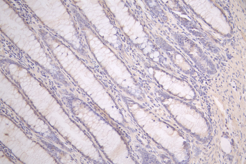 IHC image of PRIMPOL Antibody diluted at 1:50 and staining in paraffin-embedded human colorectal cancer performed on a Leica BondTM system. After dewaxing and hydration, antigen retrieval was mediated by high pressure in a citrate buffer (pH 6.0). Section was blocked with 10% normal goat serum 30min at RT. Then primary antibody (1% BSA) was incubated at 4°C overnight. The primary is detected by a Goat anti-rabbit polymer IgG labeled by HRP and visualized using 0.05% DAB.Rabbit anti-Human PRIMPOL Polyclonal Antibody