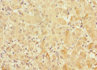 Immunohistochemistry of paraffin-embedded human liver cancer using the antibody at dilution of 1:100Rabbit anti-Human FRMD6 Polyclonal Antibody