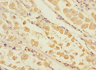 Immunohistochemistry of paraffin-embedded human gastric cancer using RCHY1 Antibody at dilution of 1:100