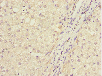Immunohistochemistry of paraffin-embedded human liver cancer using IWS1 Antibody at dilution of 1:100