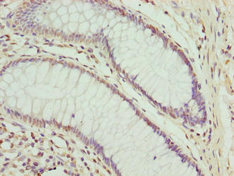 Immunohistochemistry of paraffin-embedded human colon cancer using CPXCR1 Antibody at dilution of 1:100Rabbit anti-Human CPXCR1 Polyclonal Antibody