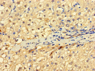 Immunohistochemistry of paraffin-embedded human liver cancer using RNF182 Antibody at dilution of 1:100Rabbit anti-Human RNF182 Polyclonal Antibody