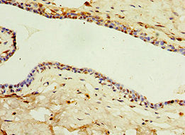 Immunohistochemistry of paraffin-embedded human breast cancer using IL22RA1 Antibody at dilution of 1:100Rabbit anti-Human IL22RA1 Polyclonal Antibody