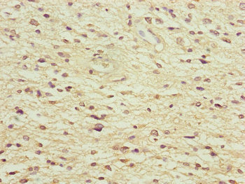 Immunohistochemistry of paraffin-embedded human glioma using NEDD1 Antibody at dilution of 1:100Rabbit anti-Human NEDD1 Polyclonal Antibody