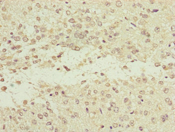 Immunohistochemistry of paraffin-embedded human glioma using NEDD1 Antibody at dilution of 1:100Rabbit anti-Human NEDD1 Polyclonal Antibody