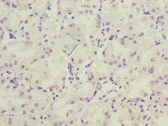 Immunohistochemistry of paraffin-embedded human gastric cancer using LRRC20 Antibody at dilution of 1:100