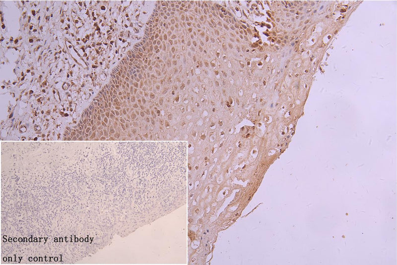 IHC image of SLC22A17 Antibody diluted at 1:200 and staining in paraffin-embedded human cervical cancer performed on a Leica BondTM system. After dewaxing and hydration, antigen retrieval was mediated by high pressure in a citrate buffer (pH 6.0). Section was blocked with 10% normal goat serum 30min at RT. Then primary antibody (1% BSA) was incubated at 4°C overnight. The primary is detected by a biotinylated secondary antibody and visualized using an HRP conjugated SP system.Rabbit anti-Human SLC22A17 Polyclonal Antibody