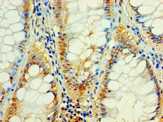Immunohistochemistry of paraffin-embedded human colon cancer using C4orf3 Antibody at dilution of 1:100