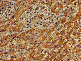 Immunohistochemistry of paraffin-embedded human liver cancer using APOBEC4 Antibody at dilution of 1:100Rabbit anti-Human APOBEC4 Polyclonal Antibody