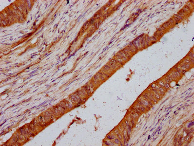 IHC image of LMO7 Antibody diluted at 1:200 and staining in paraffin-embedded human colon cancer performed on a Leica BondTM system. After dewaxing and hydration, antigen retrieval was mediated by high pressure in a citrate buffer (pH 6.0). Section was blocked with 10% normal goat serum 30min at RT. Then primary antibody (1% BSA) was incubated at 4°C overnight. The primary is detected by a biotinylated secondary antibody and visualized using an HRP conjugated SP system.Rabbit anti-Human LMO7 Polyclonal Antibody