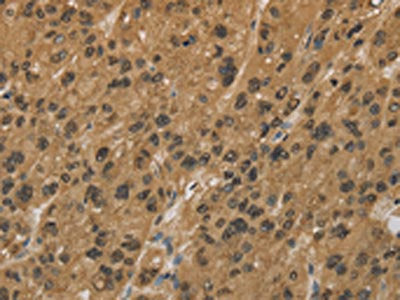 The image on the left is immunohistochemistry of paraffin-embedded Human liver cancer tissue using HSPA4 Antibody(HSPA4 Antibody) at dilution 1/25, on the right is treated with fusion protein. (Original magnification: ×200)Rabbit anti-Human HSPA4 Polyclonal Antibody