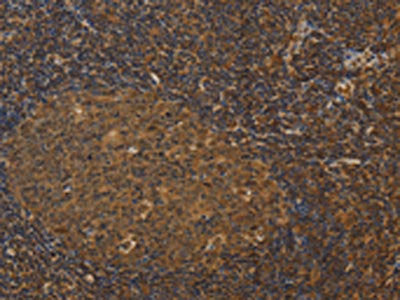 The image on the left is immunohistochemistry of paraffin-embedded Human tonsil tissue using the antibody Antibody) at dilution 1/25, on the right is treated with fusion protein. (Original magnification: ×200)Rabbit anti-Human HSPA4 Polyclonal Antibody
