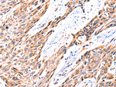 The image on the left is immunohistochemistry of paraffin-embedded Human esophagus cancer tissue using GNRHR Antibody(GNRHR Antibody) at dilution 1/117, on the right is treated with synthetic peptide. (Original magnification: ×200)Rabbit anti-Human GNRHR Polyclonal Antibody
