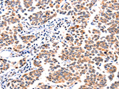 The image on the left is immunohistochemistry of paraffin-embedded Human breast cancer tissue using the antibody Antibody) at dilution 1/117, on the right is treated with synthetic peptide. (Original magnification: ×200)Rabbit anti-Human GNRHR Polyclonal Antibody