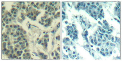 Immunohistochemical analysis of paraffin-embedded human breast carcinoma tissue using Her3/ErbB3(Phospho-Tyr1328) Antibody(left) or the same antibody preincubated with blocking peptide(right).Rabbit anti-Human ERBB3 Polyclonal Antibody