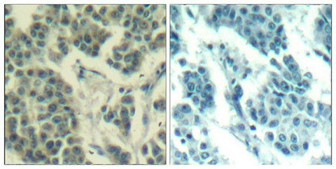 Immunohistochemical analysis of paraffin-embedded human breast carcinoma tissue using Her3/ErbB3(Phospho-Tyr1328) Antibody(left) or the same antibody preincubated with blocking peptide(right).Rabbit anti-Human ERBB3 Polyclonal Antibody