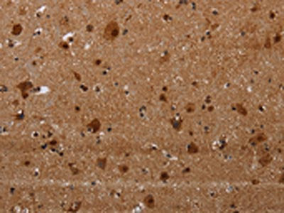The image on the left is immunohistochemistry of paraffin-embedded Human brain  tissue using MAGEE1 Antibody(MAGEE1 Antibody) at dilution 1/30, on the right is treated with synthetic peptide. (Original magnification: ×200)Rabbit anti-Human MAGEE1 Polyclonal Antibody