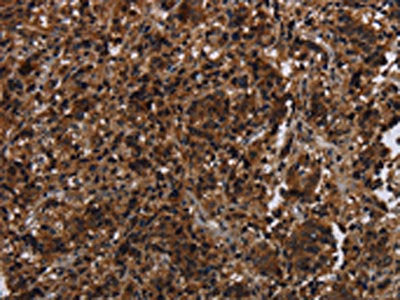 The image on the left is immunohistochemistry of paraffin-embedded Human liver cancer tissue using the antibody Antibody) at dilution 1/30, on the right is treated with synthetic peptide. (Original magnification: ×200)