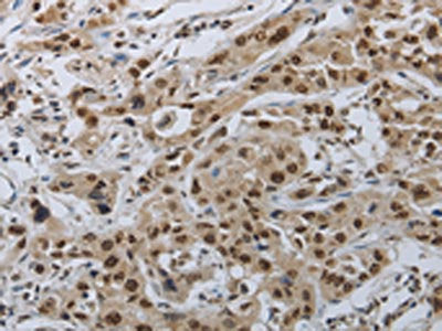 The image on the left is immunohistochemistry of paraffin-embedded Human lung cancer tissue using PRKAR1B Antibody(PRKAR1B Antibody) at dilution 1/70, on the right is treated with synthetic peptide. (Original magnification: ×200)Rabbit anti-Human PRKAR1B Polyclonal Antibody
