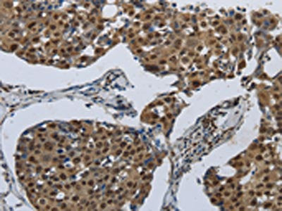 The image on the left is immunohistochemistry of paraffin-embedded Human breast cancer tissue using the antibody Antibody) at dilution 1/70, on the right is treated with synthetic peptide. (Original magnification: ×200)Rabbit anti-Human PRKAR1B Polyclonal Antibody