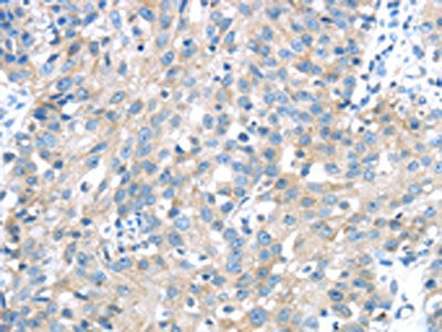 The image on the left is immunohistochemistry of paraffin-embedded Human breast cancer tissue using IGFBP3 Antibody(IGFBP3 Antibody) at dilution 1/40, on the right is treated with synthetic peptide. (Original magnification: ×200)