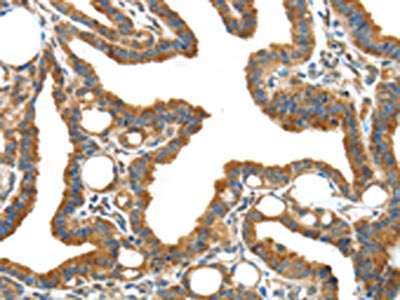 The image on the left is immunohistochemistry of paraffin-embedded Human thyroid cancer tissue using the antibody Antibody) at dilution 1/40, on the right is treated with synthetic peptide. (Original magnification: ×200)