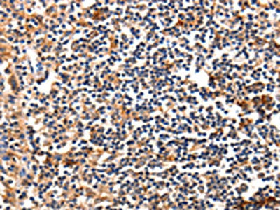 The image on the left is immunohistochemistry of paraffin-embedded Human tonsil tissue using FADD Antibody(FADD Antibody) at dilution 1/35, on the right is treated with fusion protein. (Original magnification: ×200)Rabbit anti-Human FADD Polyclonal Antibody