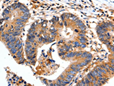 The image on the left is immunohistochemistry of paraffin-embedded Human colon cancer tissue using the antibody Antibody) at dilution 1/35, on the right is treated with fusion protein. (Original magnification: ×200)Rabbit anti-Human FADD Polyclonal Antibody