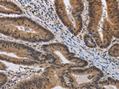 The image on the left is immunohistochemistry of paraffin-embedded Human colon cancer tissue using the antibody Antibody) at dilution 1/40, on the right is treated with synthetic peptide. (Original magnification: ×200)