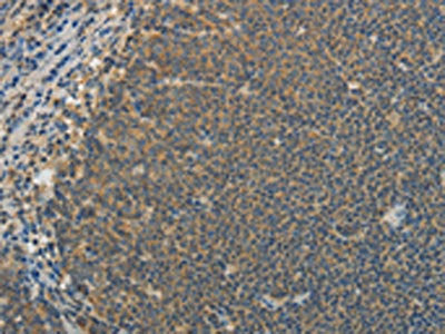 The image on the left is immunohistochemistry of paraffin-embedded Human lymphoma tissue using IL1B Antibody(IL1B Antibody) at dilution 1/20, on the right is treated with fusion protein. (Original magnification: ×200)